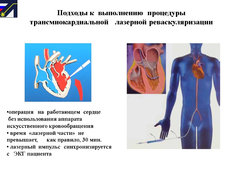 Подходы к  выполнению  процедуры  трансмиокардиальной   лазерной реваскуляризации операция 